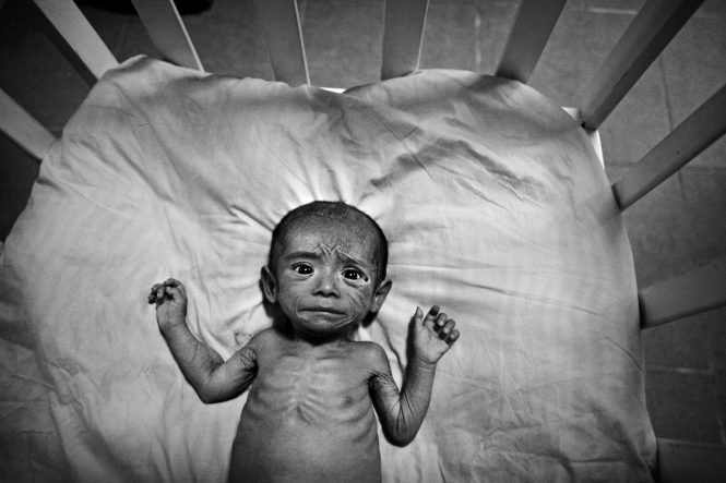 Guatemala Malnutrition - Hope of LifeZuleyca Cha Choc arrived seriously malnourished and near death at the Hope of Life malnutrition center, weighing only 6 lbs. at 7 months old. A day later, she is re-hydrated and beginning what will be a long and slow recovery.